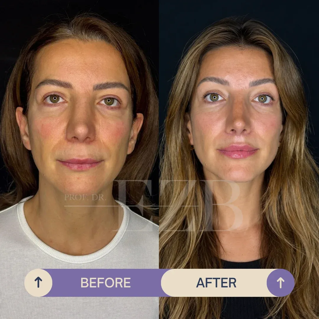 Lip Lift, before and after