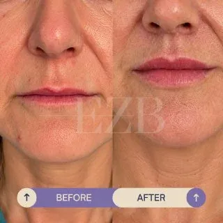 Lip Lift, before and after
