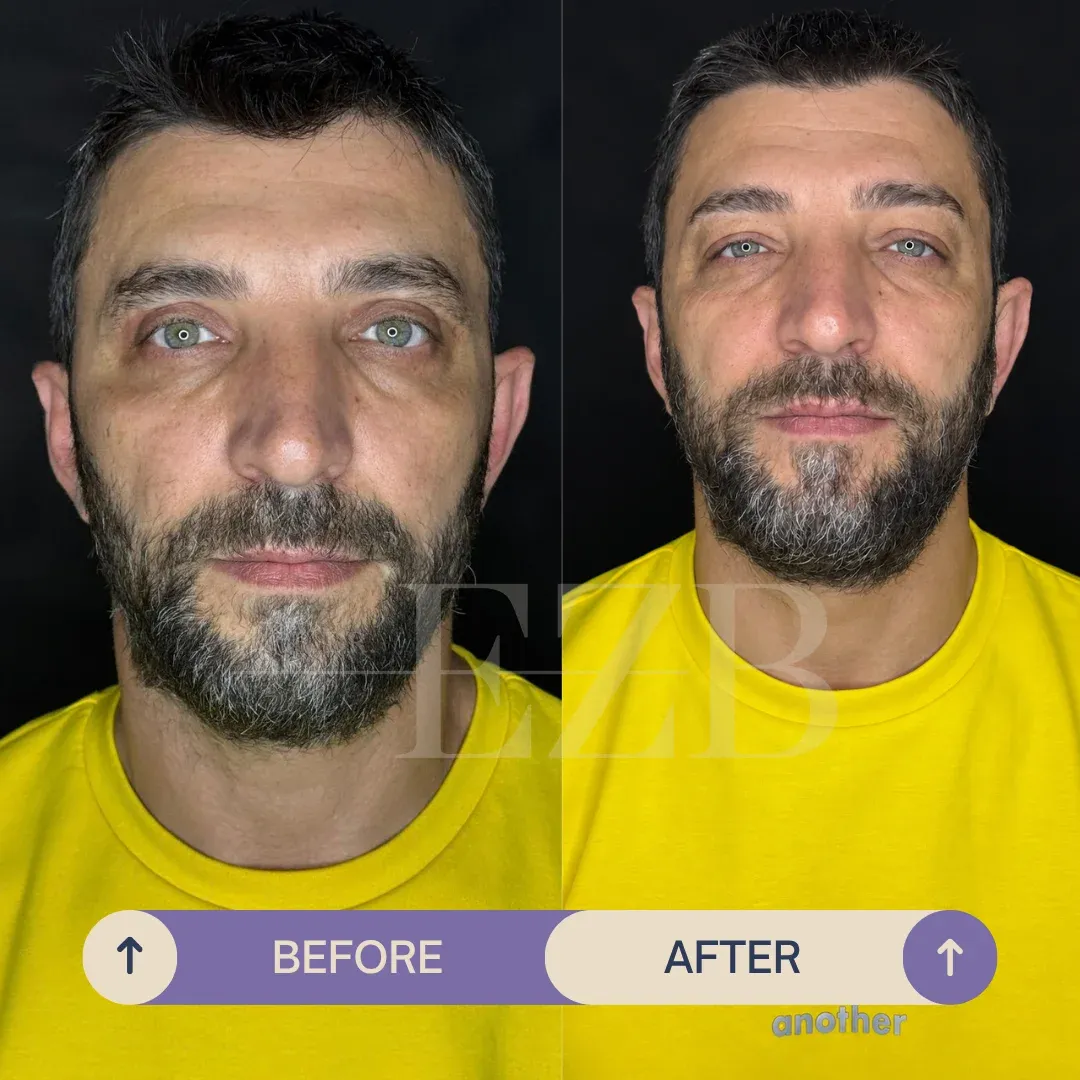 Upper Eyelid Blepharoplasty, before and after