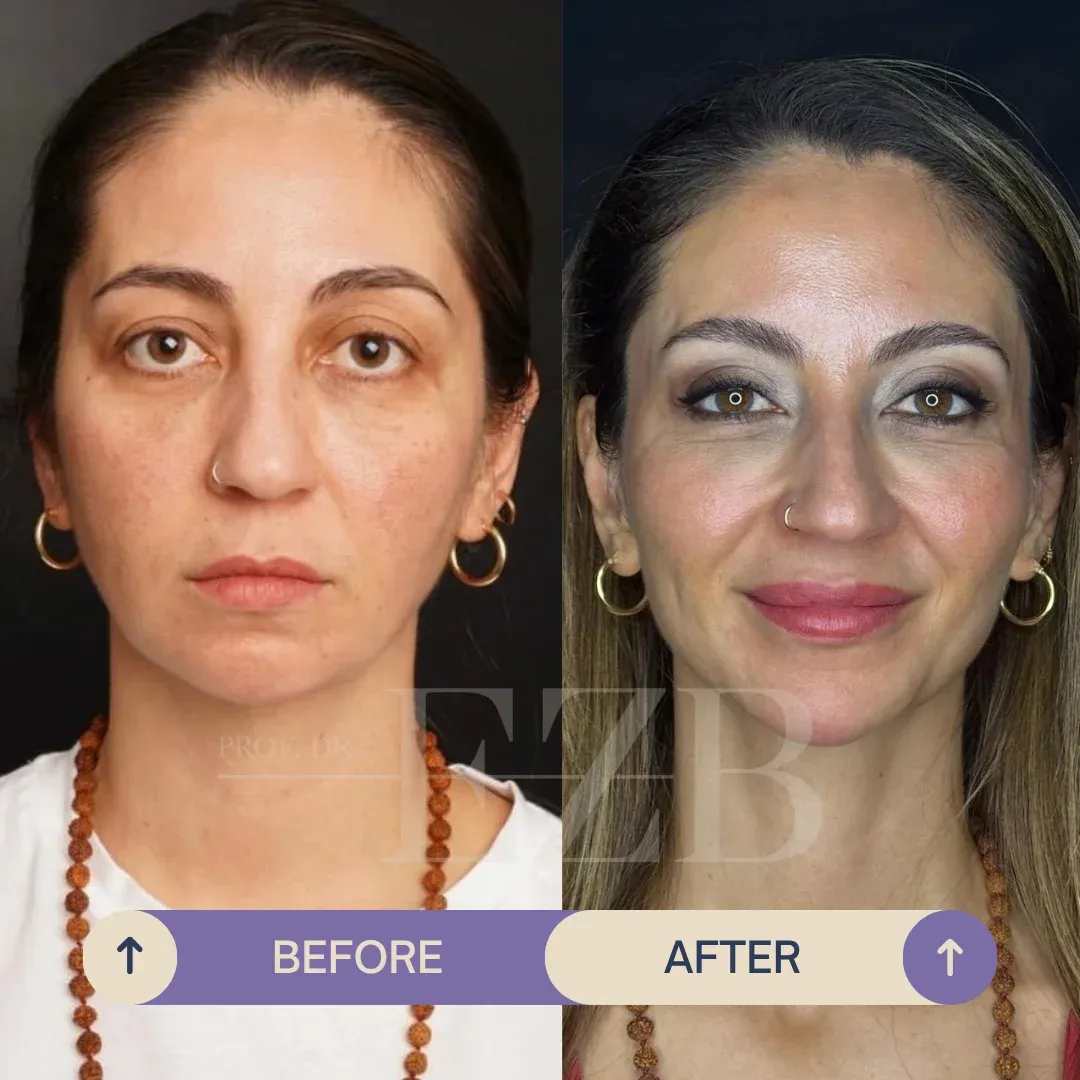 Upper Eyelid Blepharoplasty, before and after