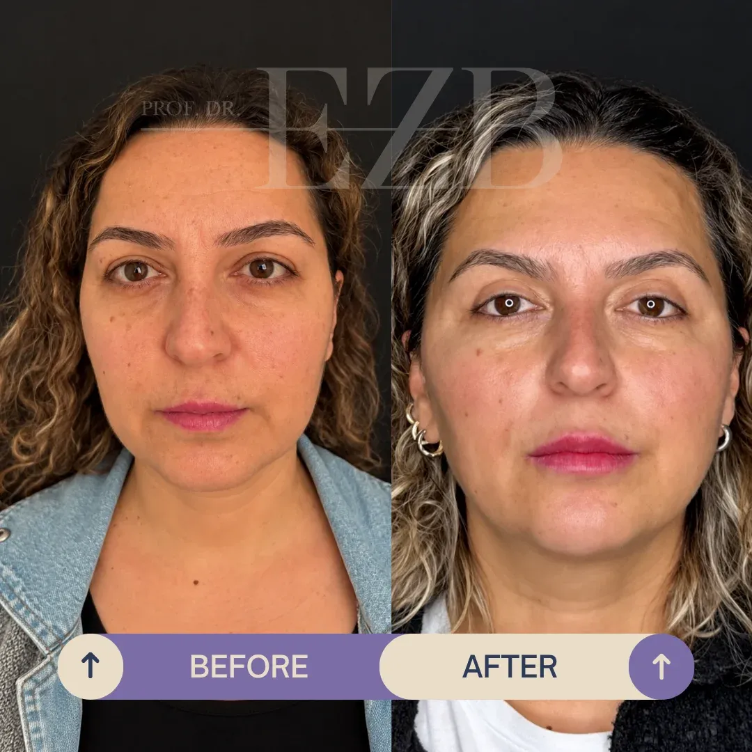 Upper Eyelid Blepharoplasty, before and after