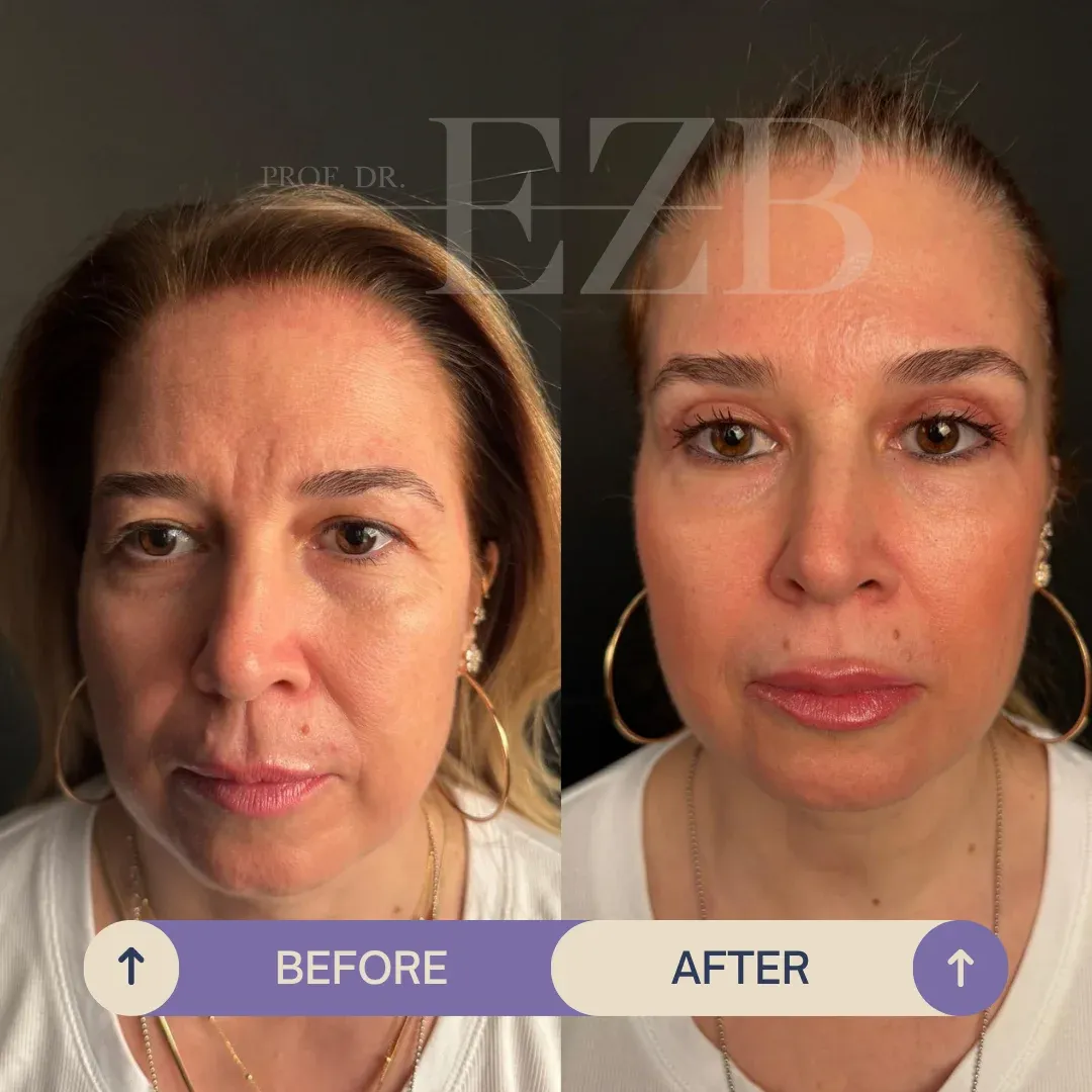 Upper Eyelid Blepharoplasty, before and after